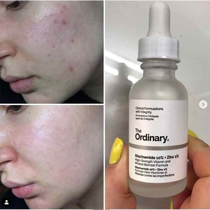 (China) Serum for problem skin The Ordinary Niacinamide 10% + Zinc 1% High Strength Vitamin and Mineral Blemish Formula, 30ml